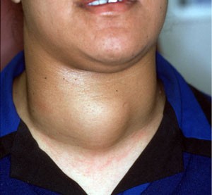 THYROID SURGERY | Dr John Chaplin Head and Neck Surgeon