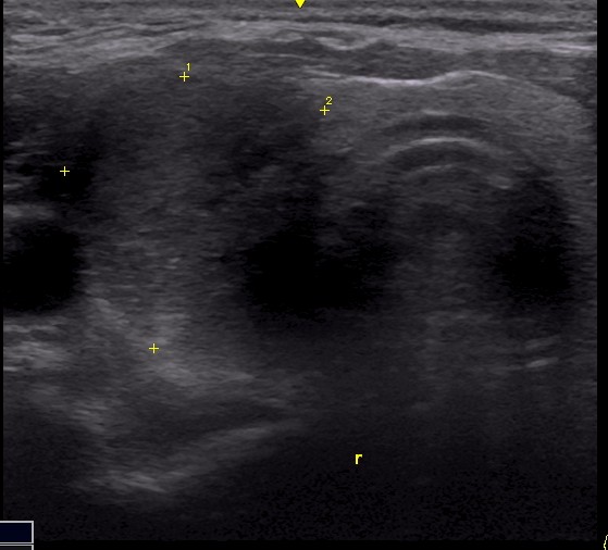 thyroid cyst ultrasound